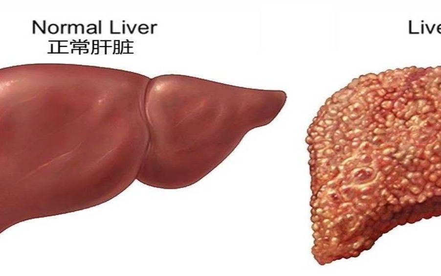 肝病肝硬化的人能喝黑茶吗,肝硬化病人能吃鸡蛋吗
